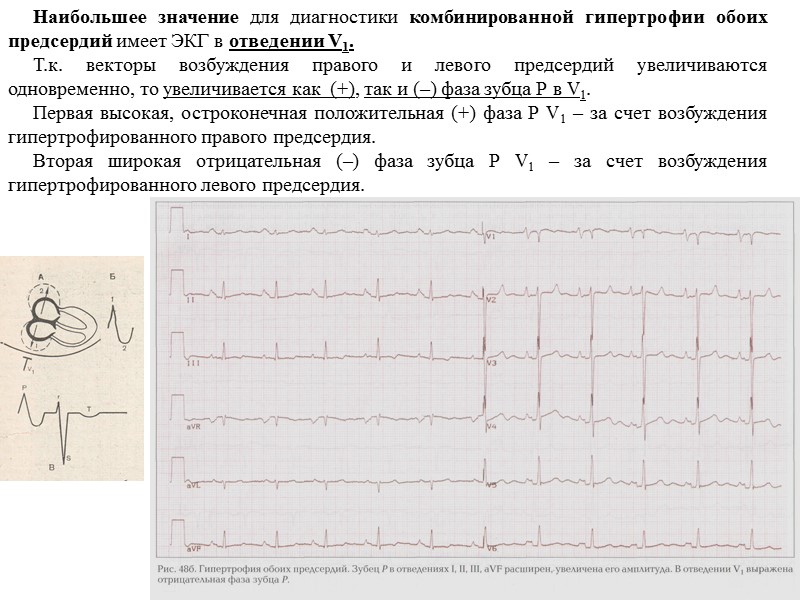 46 Наибольшее значение для диагностики комбинированной гипертрофии обоих предсердий 46 Наибольшее значение для диагностики комбинированной гипертрофии обоих предсердий